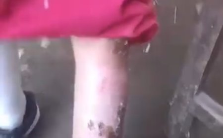 Bocah Di Jember Jadi Korban Kekerasan, Disiram Kuah Bakso Panas Oleh Tantenya Sendiri